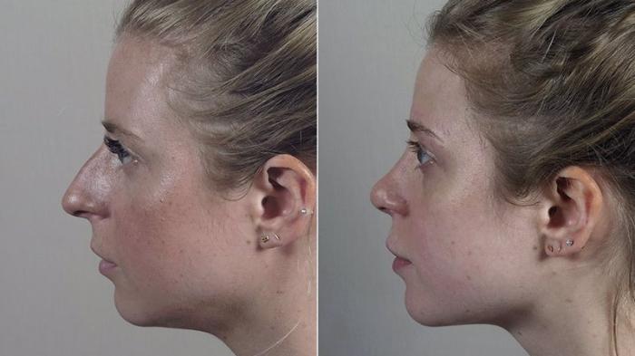 Rhinoplasty Case 207 Before & After View #2 | Paramus, New Jersey | Parker Center for Plastic Surgery