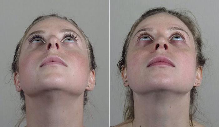 Rhinoplasty Case 207 Before & After View #3 | Paramus, New Jersey | Parker Center for Plastic Surgery