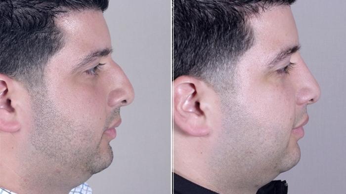 Rhinoplasty Case 951 Before & After View #5 | Paramus, New Jersey | Parker Center for Plastic Surgery