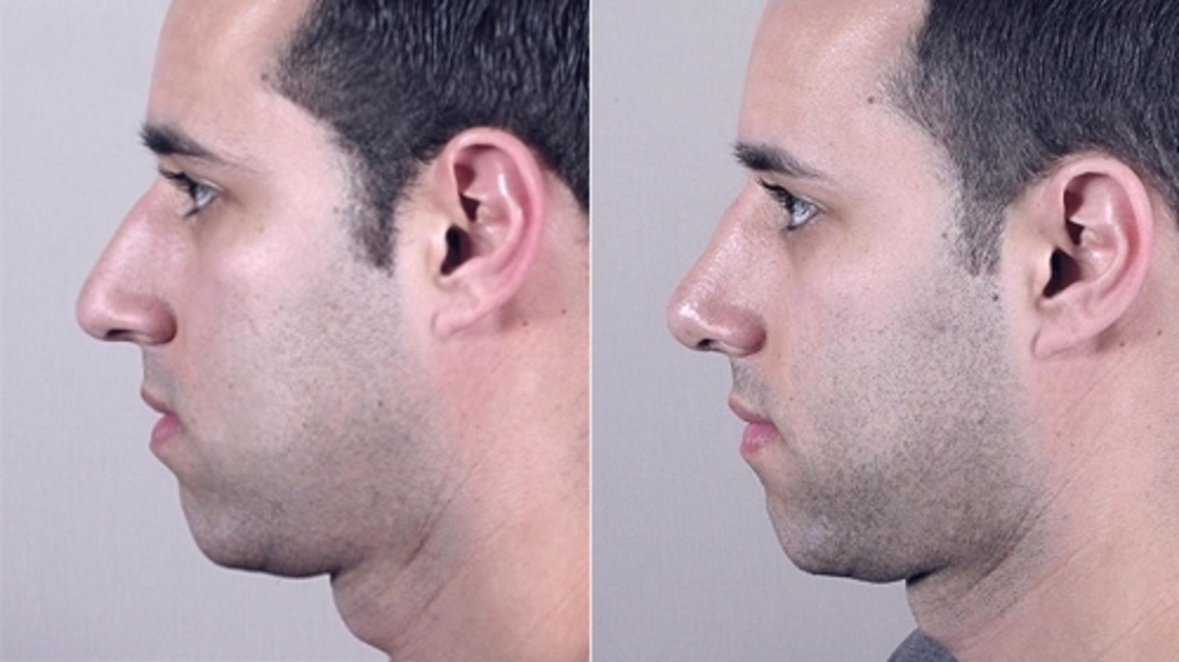 Rhinoplasty Case 952 Before & After View #5 | Paramus, New Jersey | Parker Center for Plastic Surgery