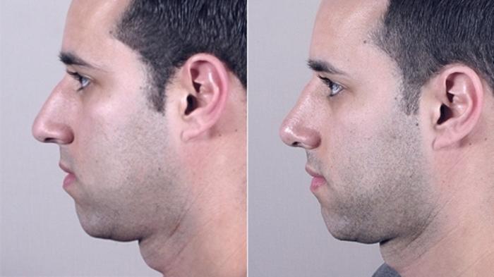 Rhinoplasty Case 952 Before & After View #5 | Paramus, New Jersey | Parker Center for Plastic Surgery