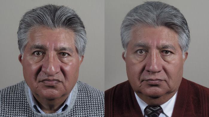 Rhinoplasty Case 967 Before & After Front | Paramus, New Jersey | Parker Center for Plastic Surgery