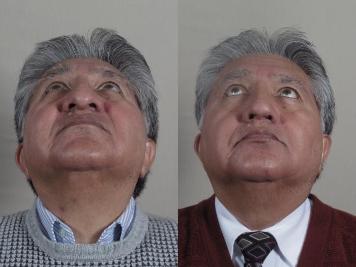 Rhinoplasty Case 967 Before & After Worms eye | Paramus, New Jersey | Parker Center for Plastic Surgery