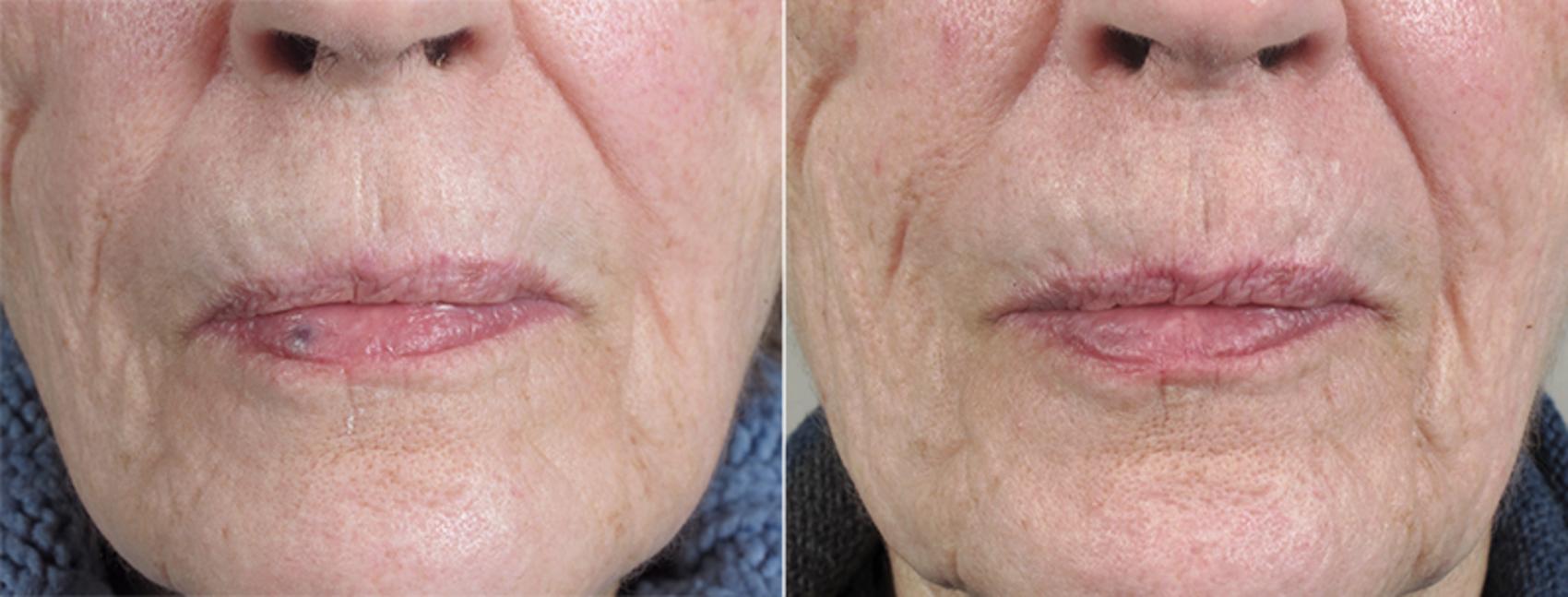 Skin Cancer Treatment Case 1035 Before & After View #1 | Paramus, New Jersey | Parker Center for Plastic Surgery