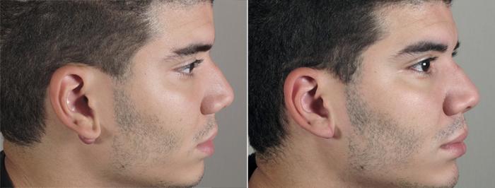 Skin Cancer Treatment Case 1036 Before & After View #1 | Paramus, New Jersey | Parker Center for Plastic Surgery