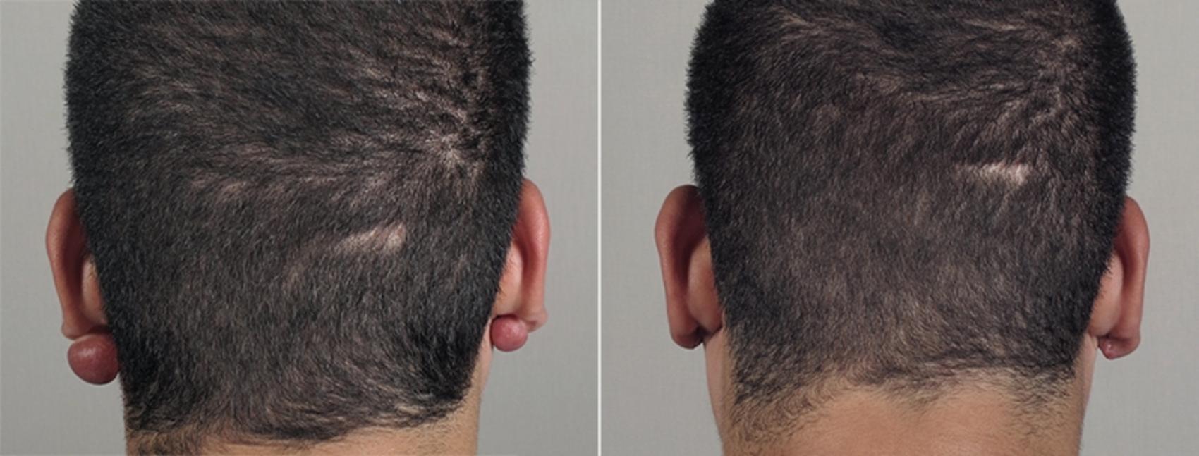 Skin Cancer Treatment Case 1036 Before & After View #2 | Paramus, New Jersey | Parker Center for Plastic Surgery