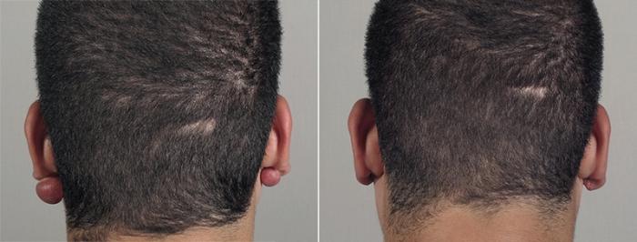 Skin Cancer Treatment Case 1036 Before & After View #2 | Paramus, New Jersey | Parker Center for Plastic Surgery