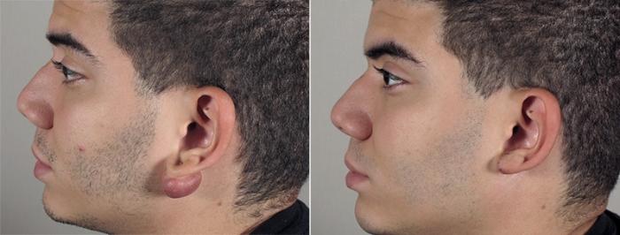 Skin Cancer Treatment Case 1036 Before & After View #3 | Paramus, New Jersey | Parker Center for Plastic Surgery