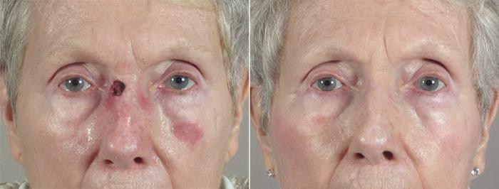 Skin Cancer Treatment Case 1037 Before & After View #1 | Paramus, New Jersey | Parker Center for Plastic Surgery