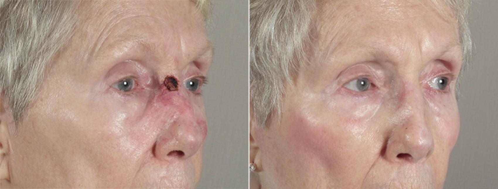 Skin Cancer Treatment Case 1037 Before & After View #2 | Paramus, New Jersey | Parker Center for Plastic Surgery