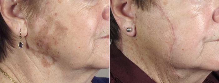 Skin Cancer Treatment Case 1038 Before & After View #1 | Paramus, New Jersey | Parker Center for Plastic Surgery