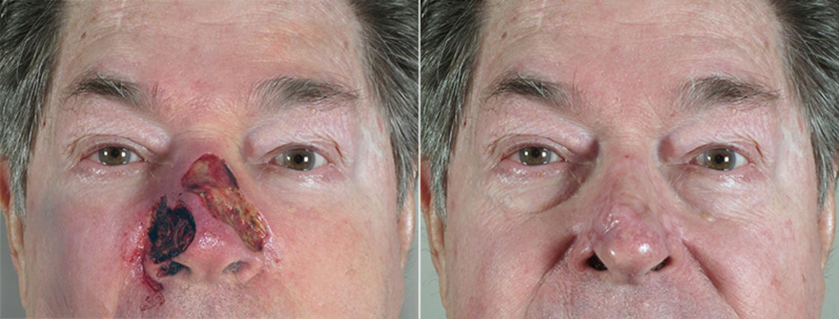 Skin Cancer Treatment Case 1040 Before & After View #1 | Paramus, New Jersey | Parker Center for Plastic Surgery