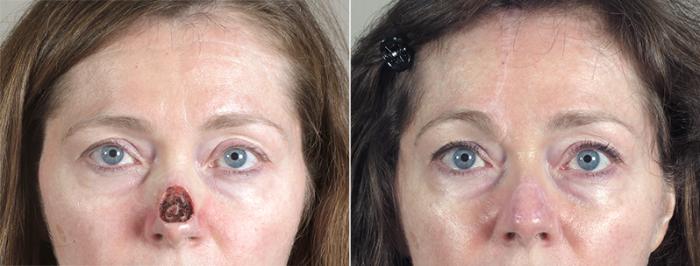 Skin Cancer Treatment Case 1041 Before & After View #1 | Paramus, New Jersey | Parker Center for Plastic Surgery