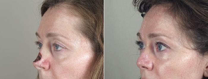 Skin Cancer Treatment Case 1041 Before & After View #2 | Paramus, New Jersey | Parker Center for Plastic Surgery