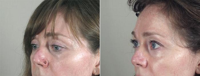 Skin Cancer Treatment Case 1041 Before & After View #3 | Paramus, New Jersey | Parker Center for Plastic Surgery