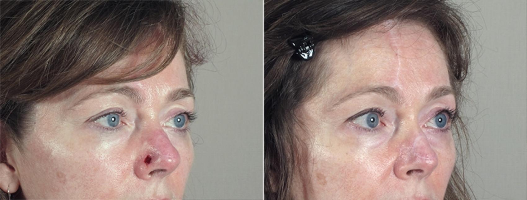 Skin Cancer Treatment Case 1041 Before & After View #4 | Paramus, New Jersey | Parker Center for Plastic Surgery