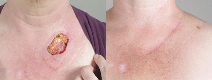 Skin Cancer Treatment Case 1042 Before & After View #1 | Paramus, New Jersey | Parker Center for Plastic Surgery