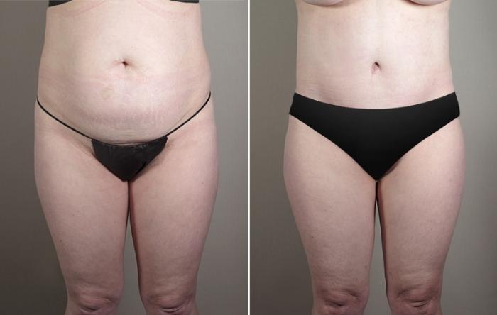Skin Cancer Treatment Case 1042 Before & After View #2 | Paramus, New Jersey | Parker Center for Plastic Surgery