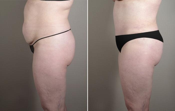 Skin Cancer Treatment Case 1042 Before & After View #3 | Paramus, New Jersey | Parker Center for Plastic Surgery