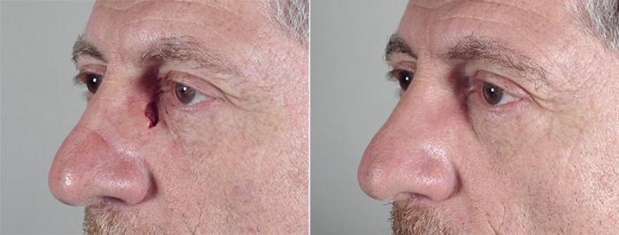 Skin Cancer Treatment Case 1044 Before & After View #1 | Paramus, New Jersey | Parker Center for Plastic Surgery