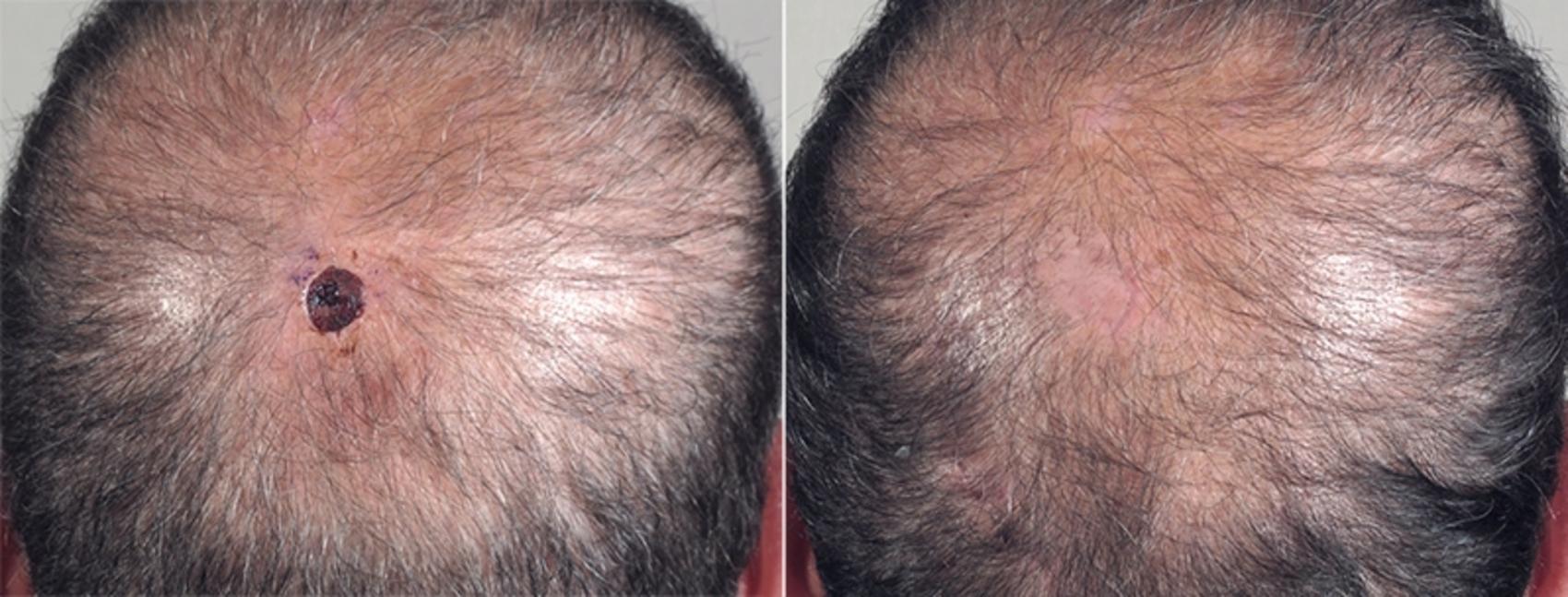 Skin Cancer Treatment Case 1044 Before & After View #2 | Paramus, New Jersey | Parker Center for Plastic Surgery