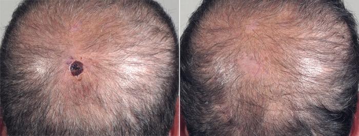 Skin Cancer Treatment Case 1044 Before & After View #2 | Paramus, New Jersey | Parker Center for Plastic Surgery