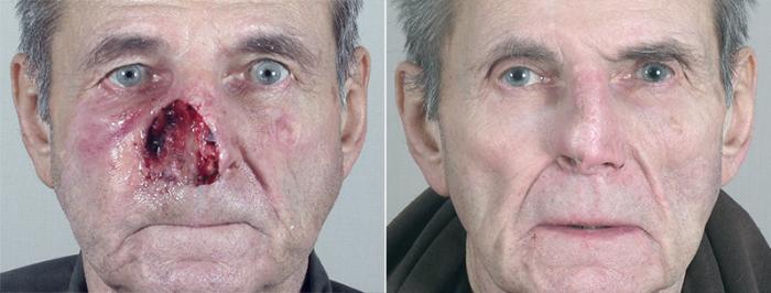 Skin Cancer Treatment Case 1045 Before & After View #1 | Paramus, New Jersey | Parker Center for Plastic Surgery