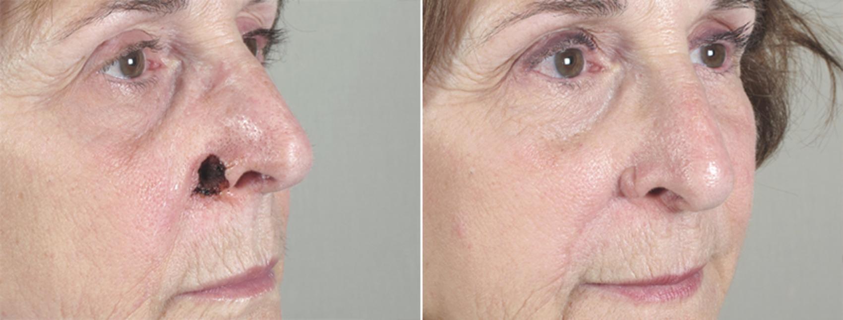 Skin Cancer Treatment Case 1046 Before & After View #1 | Paramus, New Jersey | Parker Center for Plastic Surgery