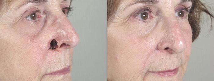 Skin Cancer Treatment Case 1046 Before & After View #1 | Paramus, New Jersey | Parker Center for Plastic Surgery