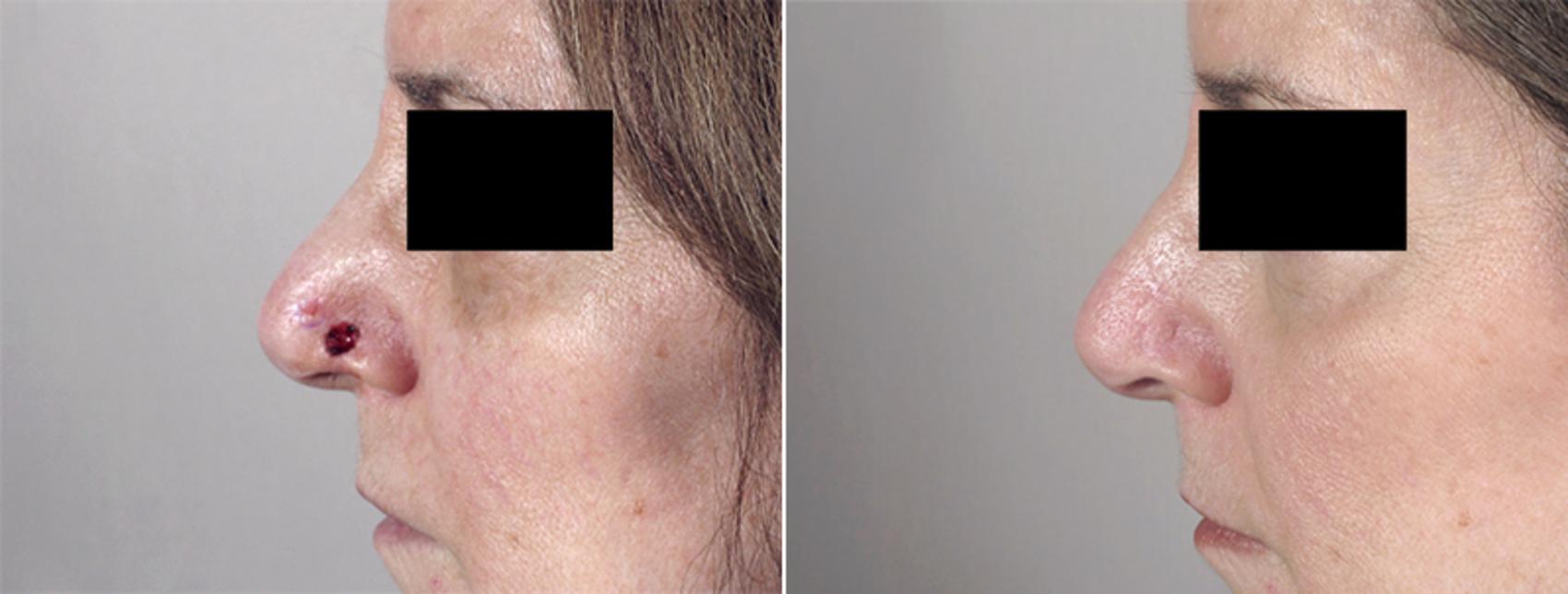 Skin Cancer Treatment Case 1047 Before & After View #1 | Paramus, New Jersey | Parker Center for Plastic Surgery