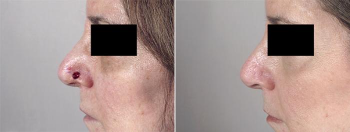 Skin Cancer Treatment Case 1047 Before & After View #1 | Paramus, New Jersey | Parker Center for Plastic Surgery