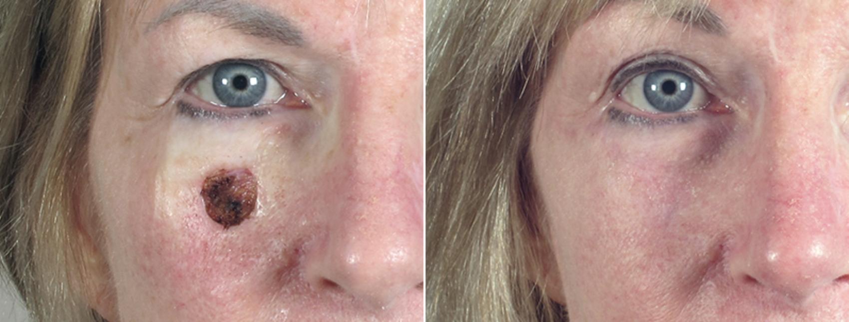 Skin Cancer Treatment Case 1048 Before & After View #1 | Paramus, New Jersey | Parker Center for Plastic Surgery