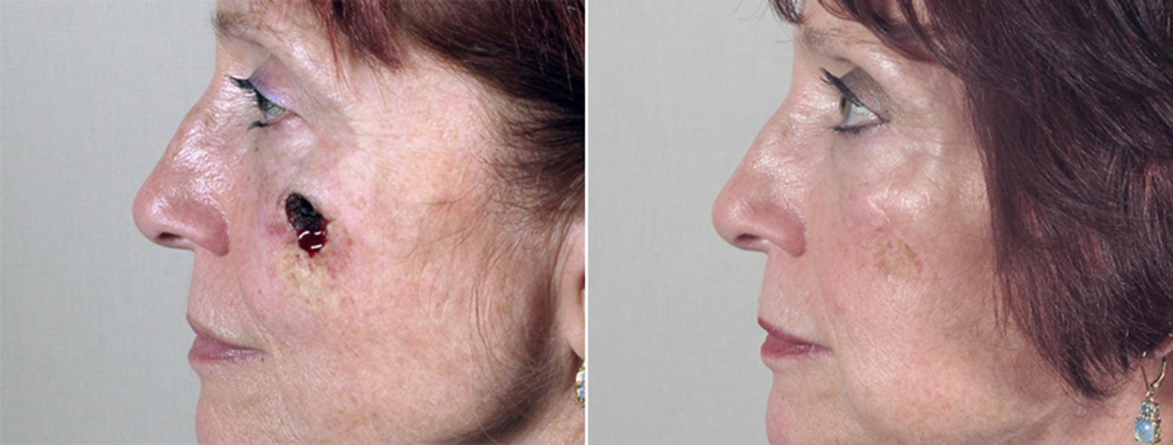 Skin Cancer Treatment Case 1049 Before & After View #1 | Paramus, New Jersey | Parker Center for Plastic Surgery