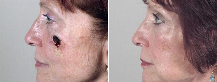 Skin Cancer Treatment Case 1049 Before & After View #1 | Paramus, New Jersey | Parker Center for Plastic Surgery