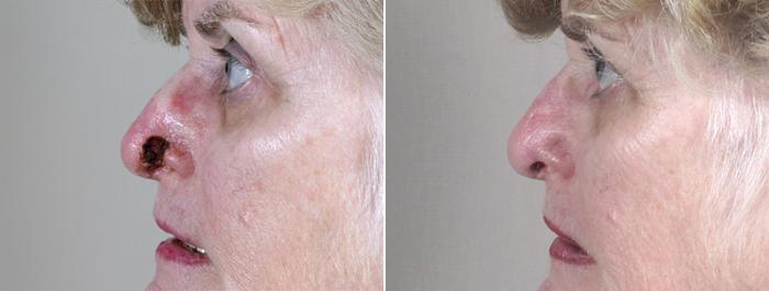 Skin Cancer Treatment Case 1050 Before & After View #1 | Paramus, New Jersey | Parker Center for Plastic Surgery