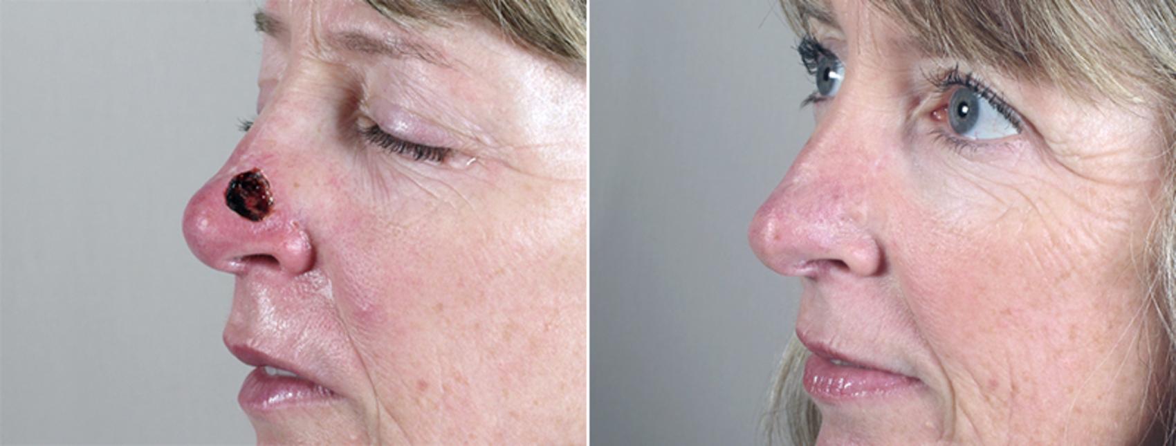 Skin Cancer Treatment Case 1051 Before & After View #1 | Paramus, New Jersey | Parker Center for Plastic Surgery
