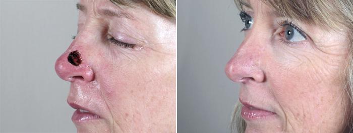 Skin Cancer Treatment Case 1051 Before & After View #1 | Paramus, New Jersey | Parker Center for Plastic Surgery