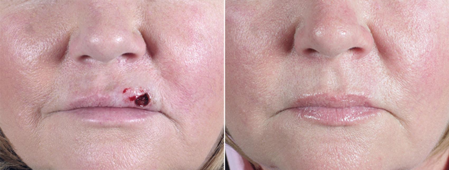 Skin Cancer Treatment Case 1052 Before & After View #1 | Paramus, New Jersey | Parker Center for Plastic Surgery