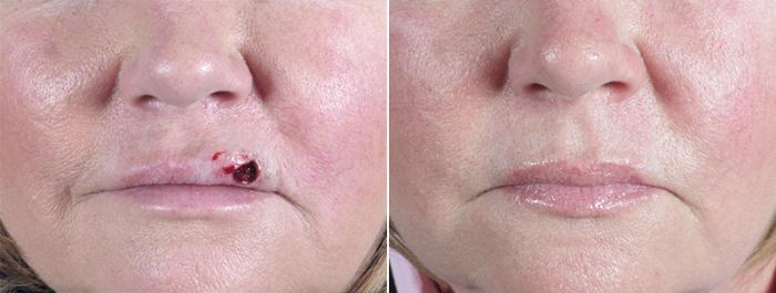 Skin Cancer Treatment Case 1052 Before & After View #1 | Paramus, New Jersey | Parker Center for Plastic Surgery