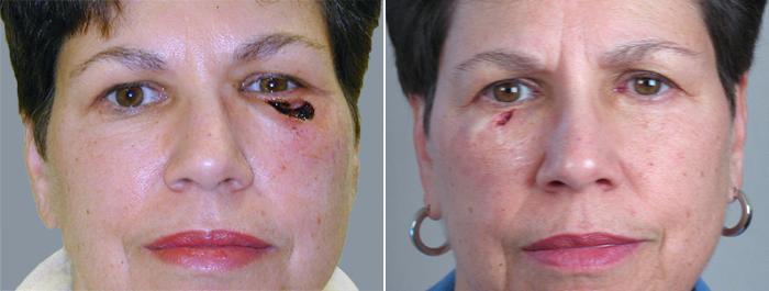 Skin Cancer Treatment Case 1053 Before & After View #1 | Paramus, New Jersey | Parker Center for Plastic Surgery