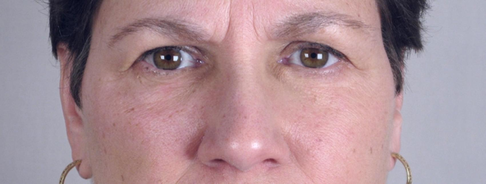 Skin Cancer Treatment Case 1053 Before & After View #2 | Paramus, New Jersey | Parker Center for Plastic Surgery