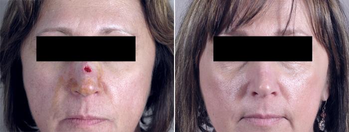 Skin Cancer Treatment Case 1054 Before & After View #1 | Paramus, New Jersey | Parker Center for Plastic Surgery