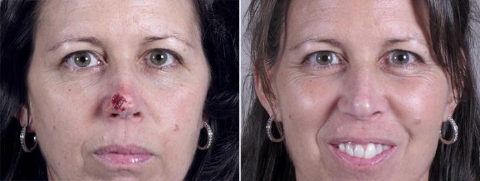 Skin Cancer Treatment Case 1055 Before & After View #1 | Paramus, New Jersey | Parker Center for Plastic Surgery