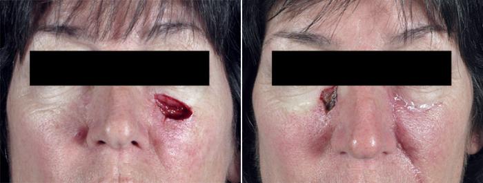 Skin Cancer Treatment Case 1056 Before & After View #1 | Paramus, New Jersey | Parker Center for Plastic Surgery