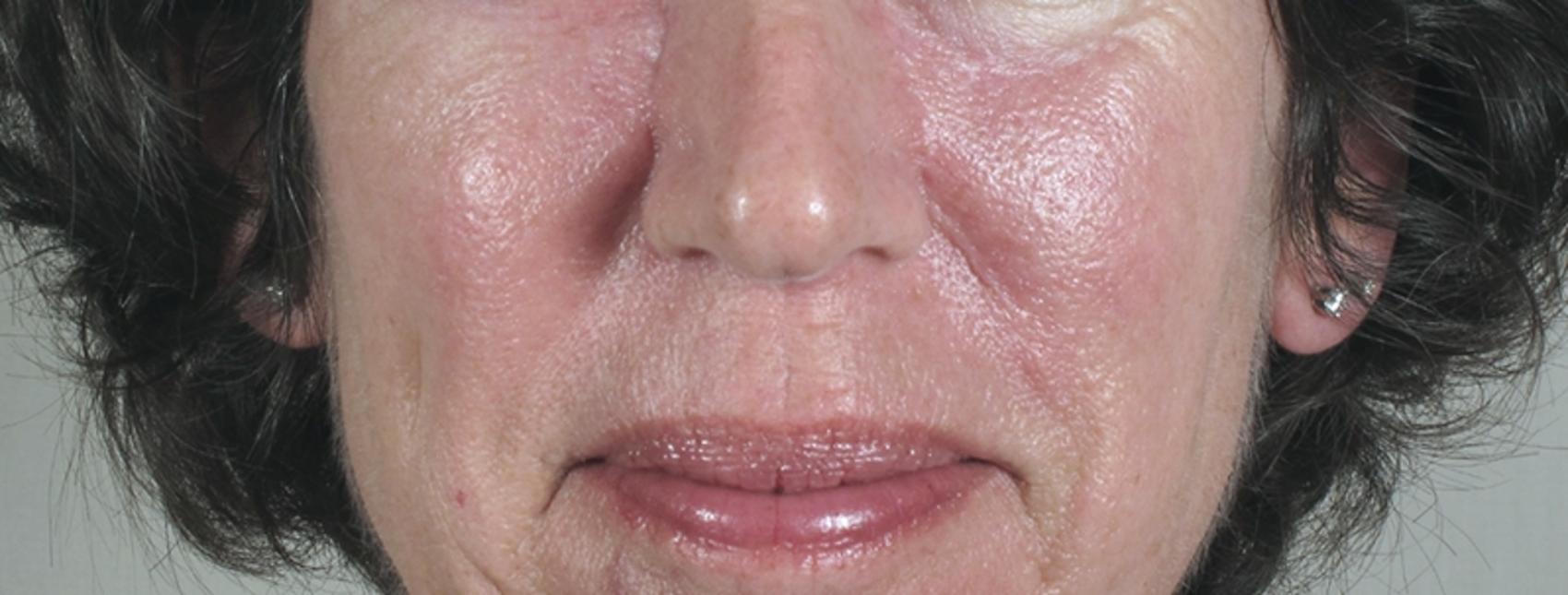 Skin Cancer Treatment Case 1056 Before & After View #2 | Paramus, New Jersey | Parker Center for Plastic Surgery