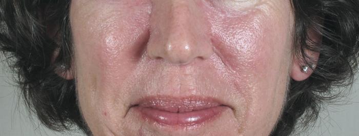Skin Cancer Treatment Case 1056 Before & After View #2 | Paramus, New Jersey | Parker Center for Plastic Surgery