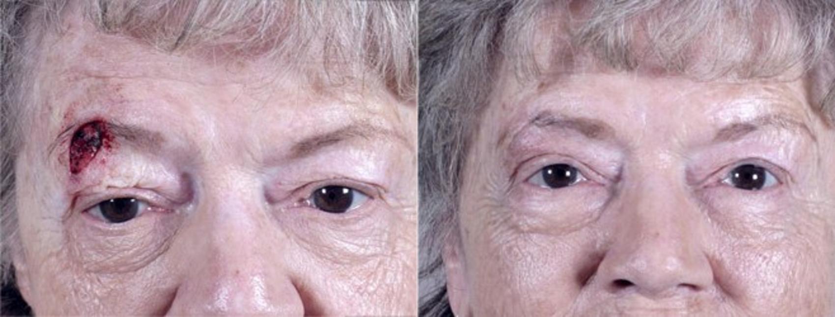 Skin Cancer Treatment Case 1057 Before & After View #1 | Paramus, New Jersey | Parker Center for Plastic Surgery