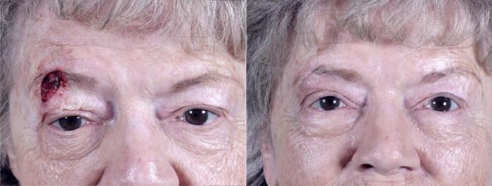 Skin Cancer Treatment Case 1057 Before & After View #1 | Paramus, New Jersey | Parker Center for Plastic Surgery