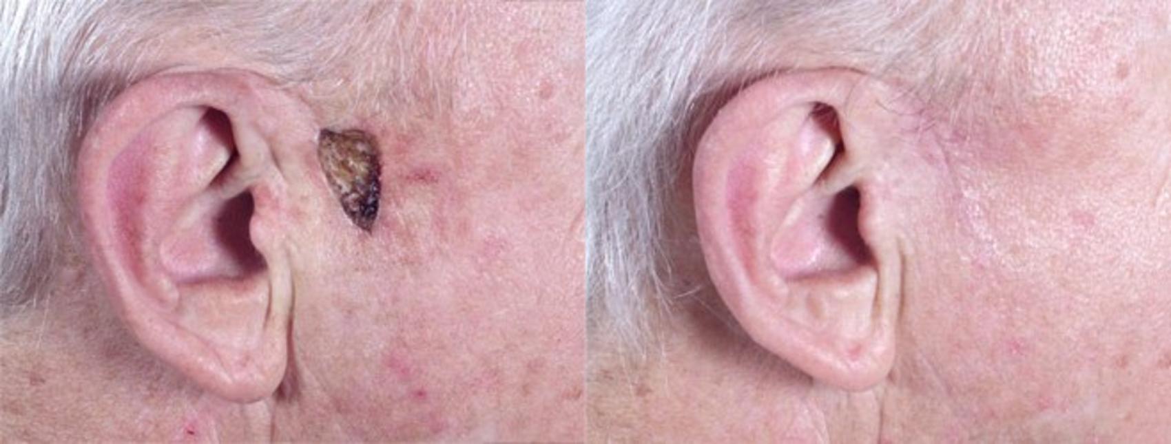Skin Cancer Treatment Case 1058 Before & After View #1 | Paramus, New Jersey | Parker Center for Plastic Surgery