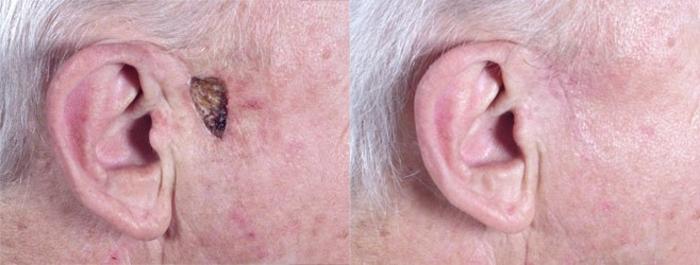 Skin Cancer Treatment Case 1058 Before & After View #1 | Paramus, New Jersey | Parker Center for Plastic Surgery